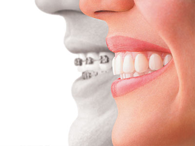 An advertisement for dental implants featuring a smiling woman with a visible tooth gap and an overlaid image of a person s teeth and mouth, emphasizing the transformation possible through dental procedures.