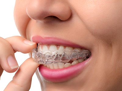 An individual in the process of wearing a dental retainer, with fingers poised over teeth.
