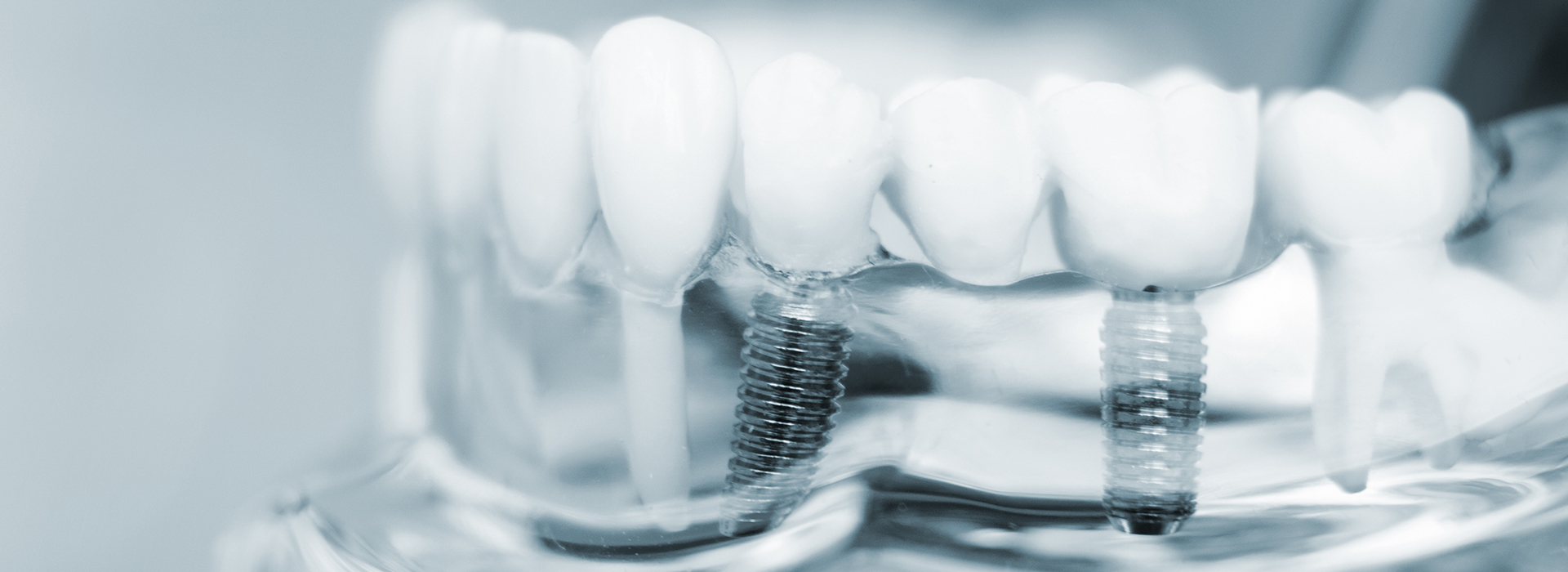 The image displays a close-up view of dental implants, showcasing their metallic components and the surrounding gum tissue.