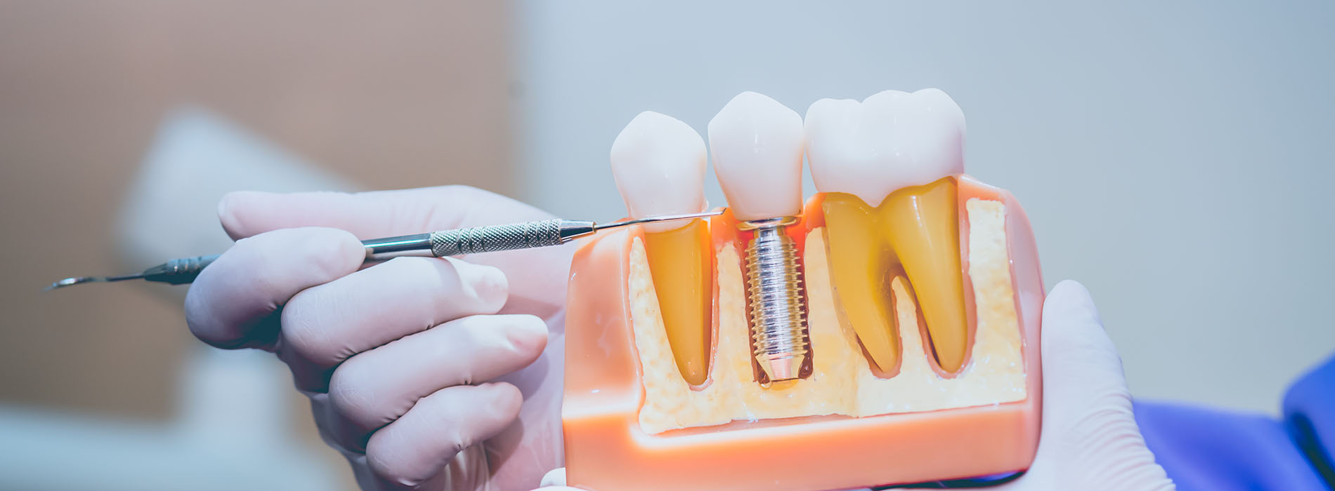 The image shows a close-up of a dental implant fixture being prepared or fitted into a plastic model of a mouth, with a person s hand holding the fixture in place.