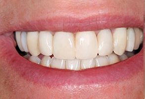The image shows a close-up of a person s smile with straight, white teeth and a clean mouth.