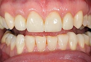 The image shows a close-up of a person s teeth, revealing a yellowish discoloration and staining on the upper front teeth.