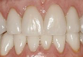The image shows a close-up of an individual s teeth, which appear to be in the process of being straightened with braces.