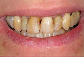 A close-up of a person s mouth with yellowed teeth and a partial smile, showcasing dental decay.
