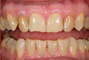 The image shows a close-up of a person s teeth, displaying a yellowish hue and some signs of wear or decay.