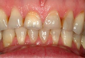The image displays a close-up of a person s teeth with visible yellowing and staining, particularly on the front teeth.