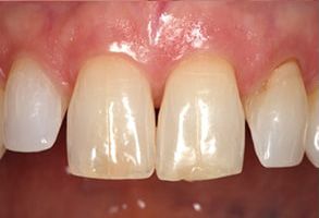 Dental implant with a damaged crown, showing signs of wear and discoloration.